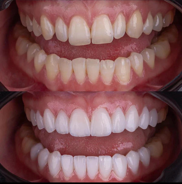 Facetas Odontológicas Removíveis Saude & Beleza (Facetas Odontológicas 1) Dm Stores