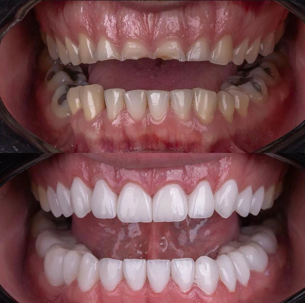 Facetas Odontológicas Removíveis Saude & Beleza (Facetas Odontológicas 1) Dm Stores